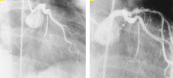 Angiography of the first patient who received a stent to treat acute vessel closure 