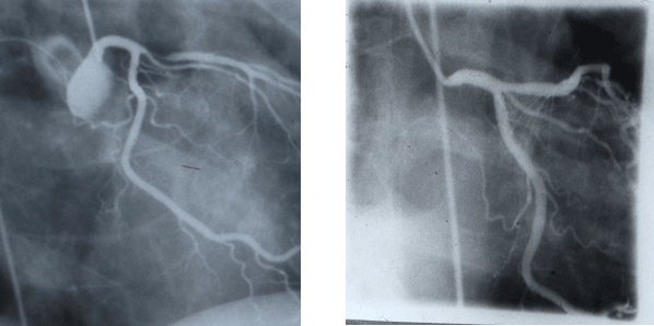 Restenotic lesion on the left treated with the Wallstent in 1986